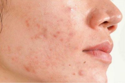 ​为什么会形成痘印 形成痘印的原因