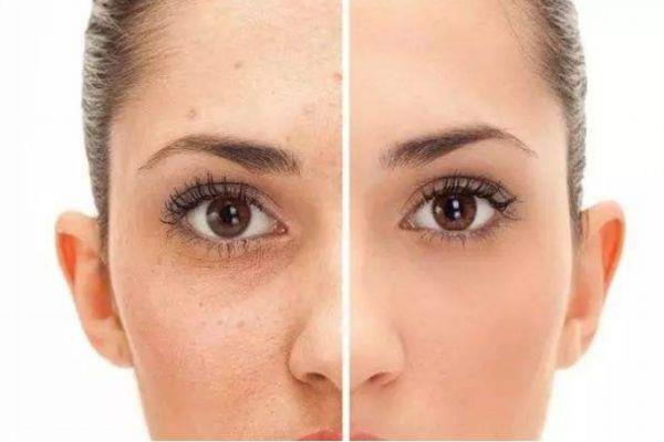 为什么会形成痘印 形成痘印的原因